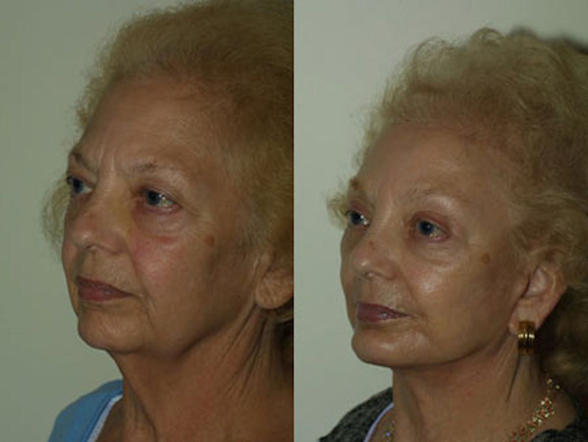 Face Before & After Gallery - Patient 245643 - Image 2
