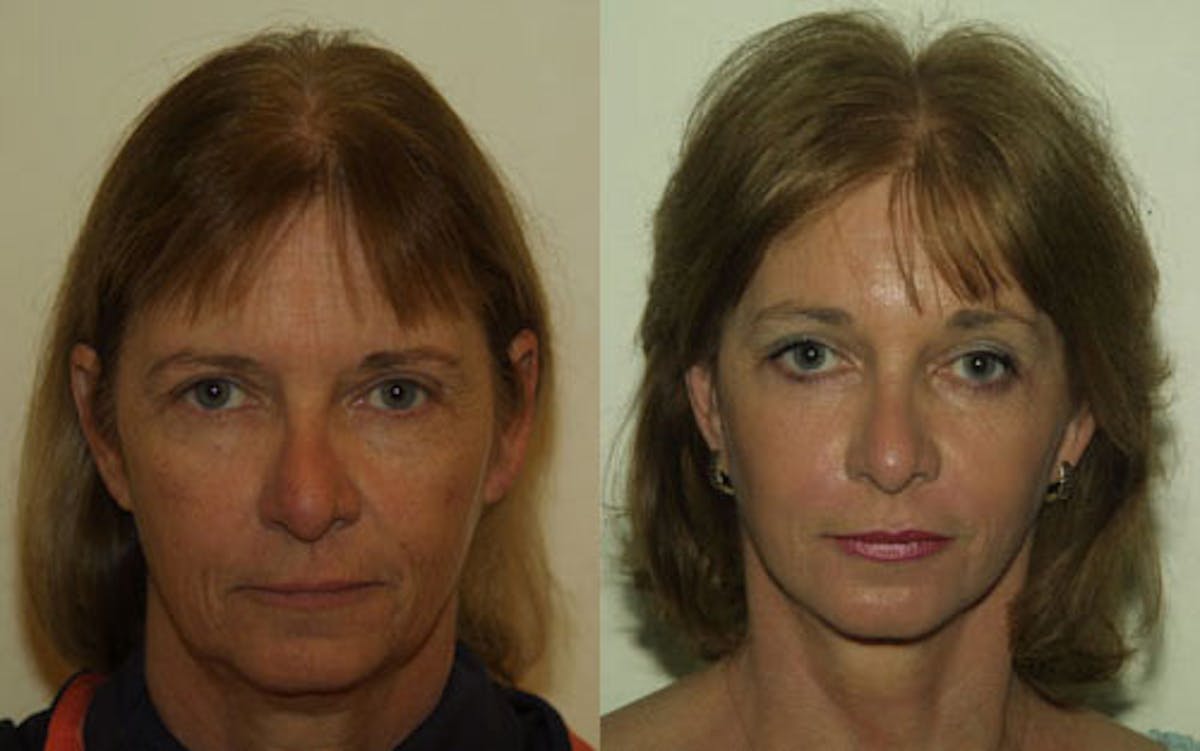 Face Before & After Gallery - Patient 583629 - Image 1