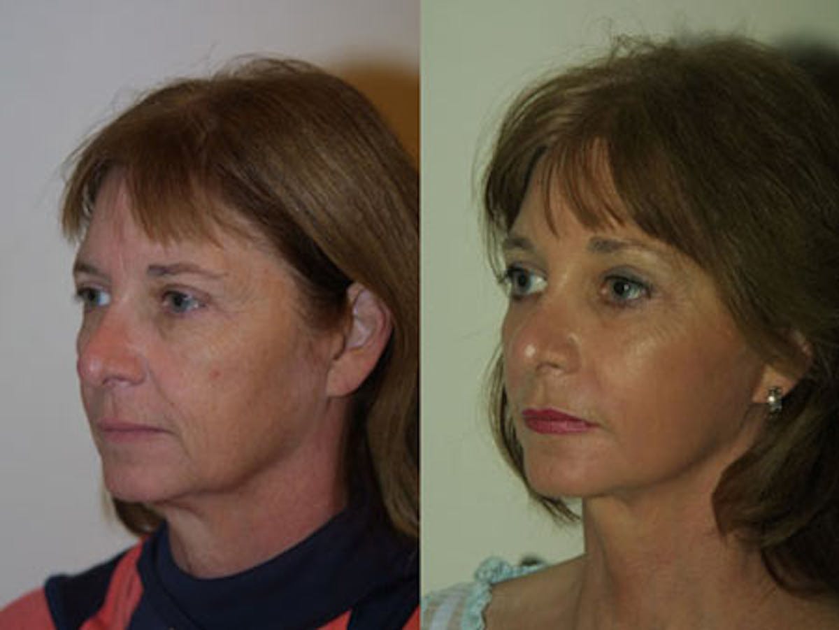 Face Before & After Gallery - Patient 583629 - Image 2