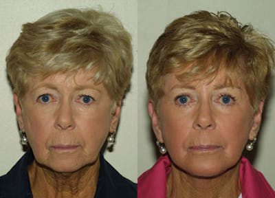 Face Before & After Gallery - Patient 531823 - Image 1