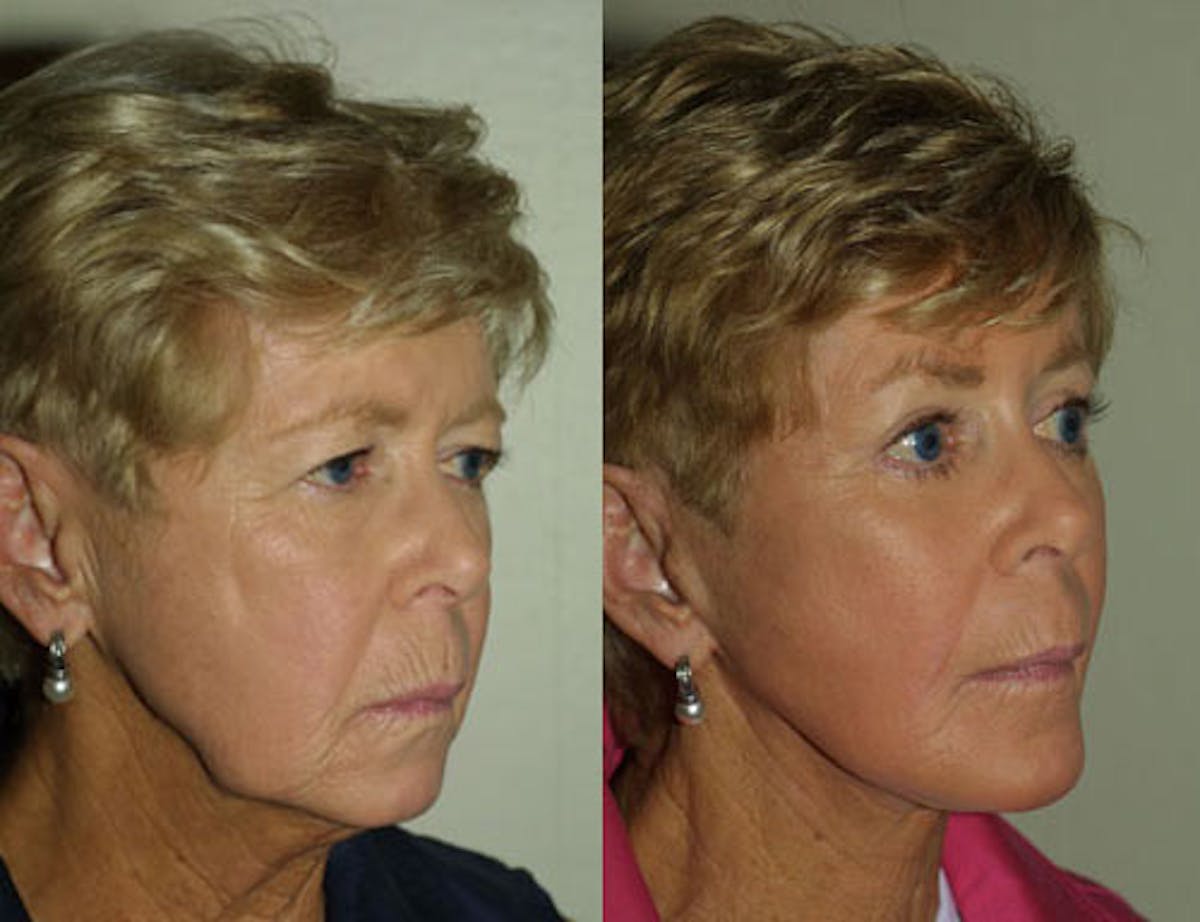 Face Before & After Gallery - Patient 531823 - Image 2