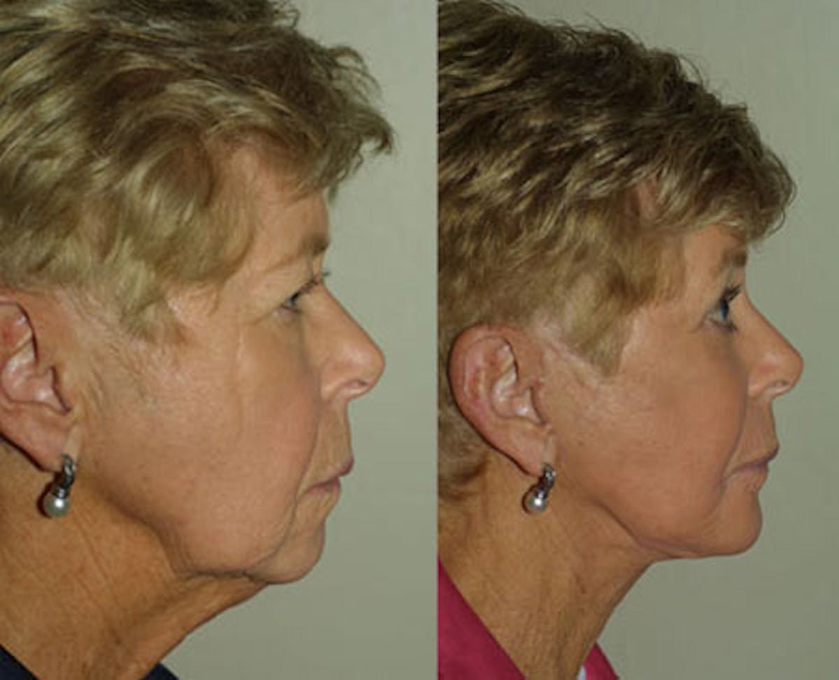 Face Before & After Gallery - Patient 531823 - Image 3