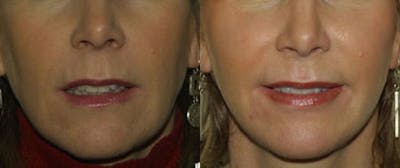 Face Before & After Gallery - Patient 312878 - Image 1