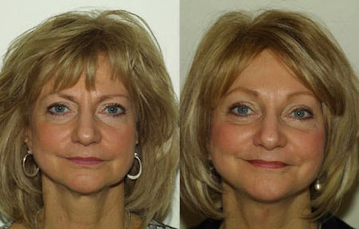 Face Before & After Gallery - Patient 345380 - Image 1