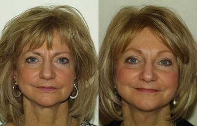 Face Before & After Gallery - Patient 345380 - Image 1