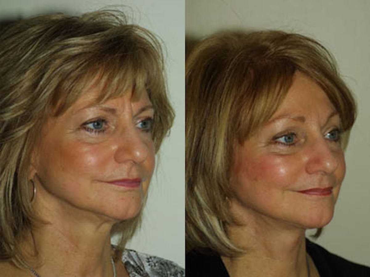 Face Before & After Gallery - Patient 345380 - Image 2