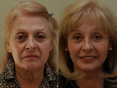 Face Before & After Gallery - Patient 184003 - Image 1