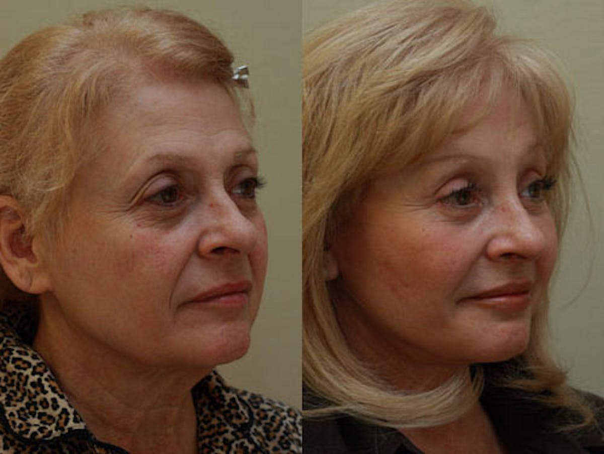 Facelift Before & After Gallery - Patient 244338 - Image 2