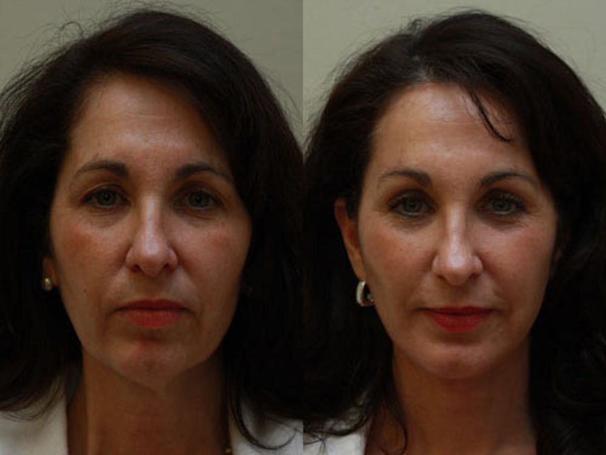 Face Before & After Gallery - Patient 357823 - Image 1