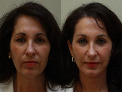 Face Before & After Gallery - Patient 357823 - Image 1