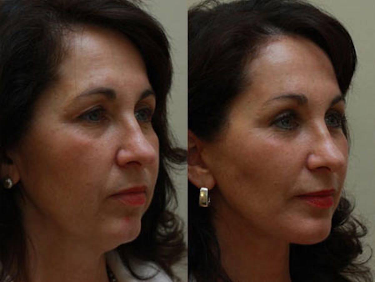 Face Before & After Gallery - Patient 357823 - Image 2