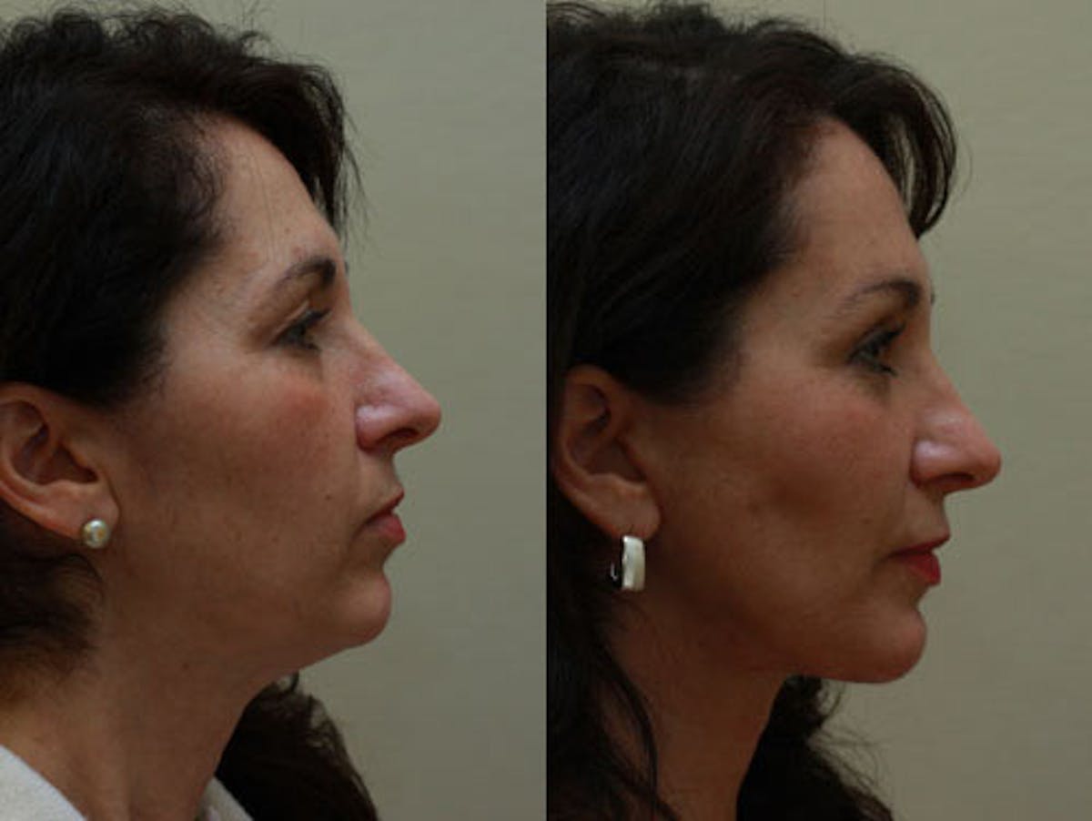 Face Before & After Gallery - Patient 357823 - Image 3