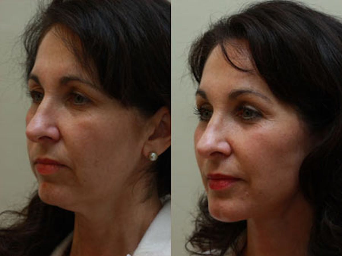 Face Before & After Gallery - Patient 357823 - Image 4