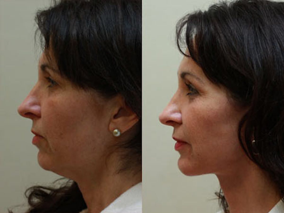Face Before & After Gallery - Patient 357823 - Image 5