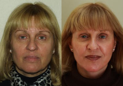 Face Before & After Gallery - Patient 748217 - Image 1