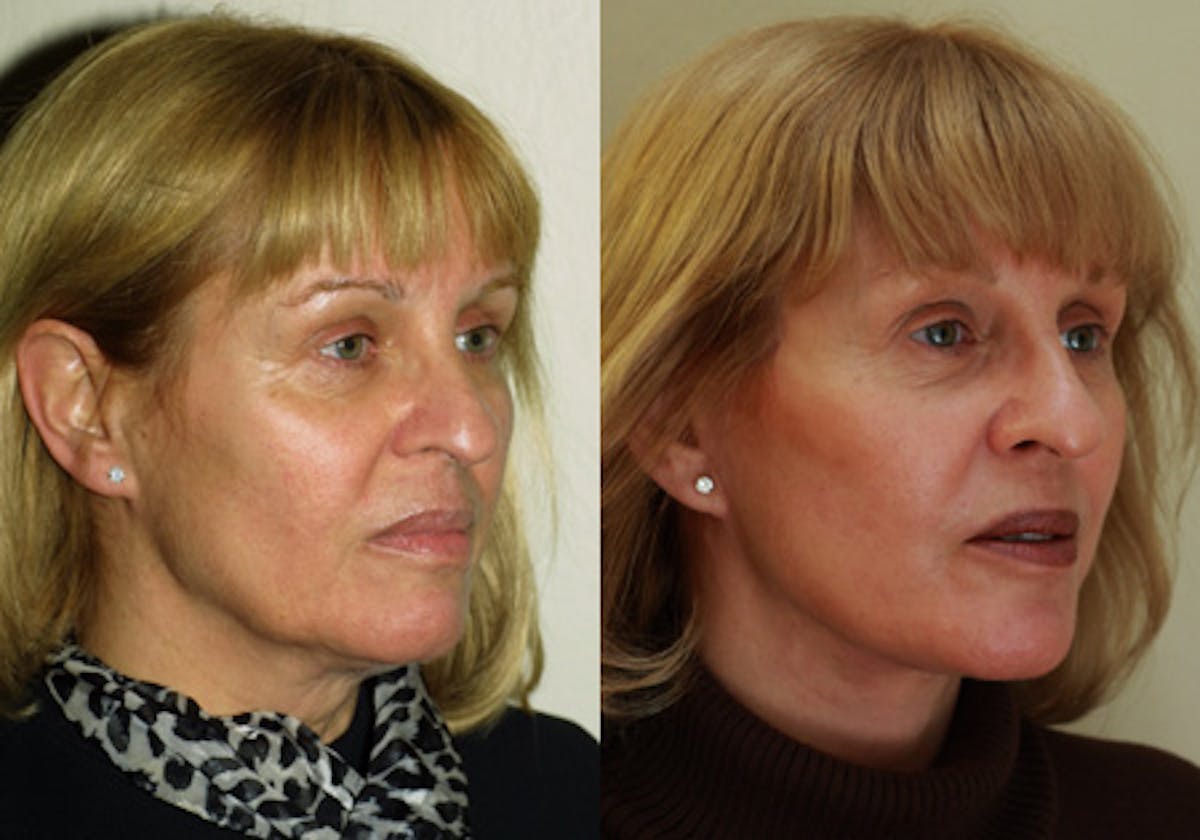 Face Before & After Gallery - Patient 748217 - Image 2