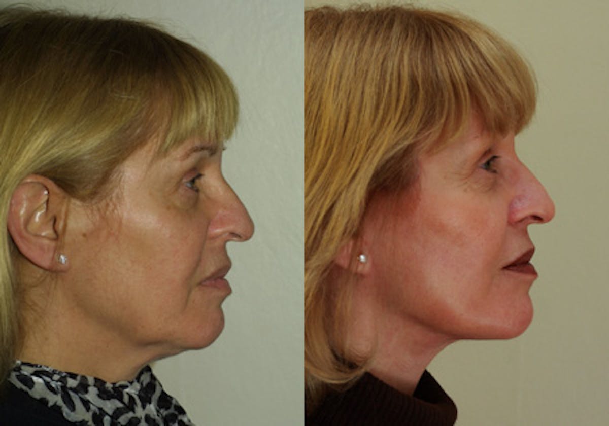 Face Before & After Gallery - Patient 748217 - Image 3