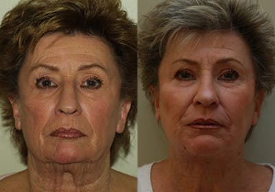 Face Before & After Gallery - Patient 130571 - Image 1