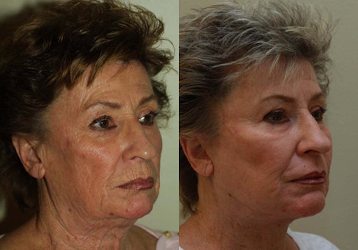 Facelift Before & After Gallery - Patient 311728 - Image 2