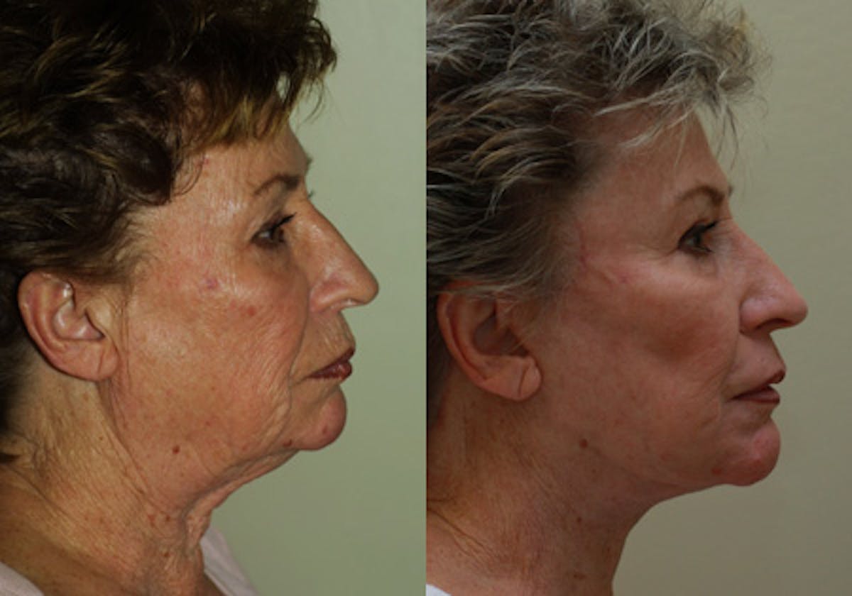 Facelift Before & After Gallery - Patient 311728 - Image 3