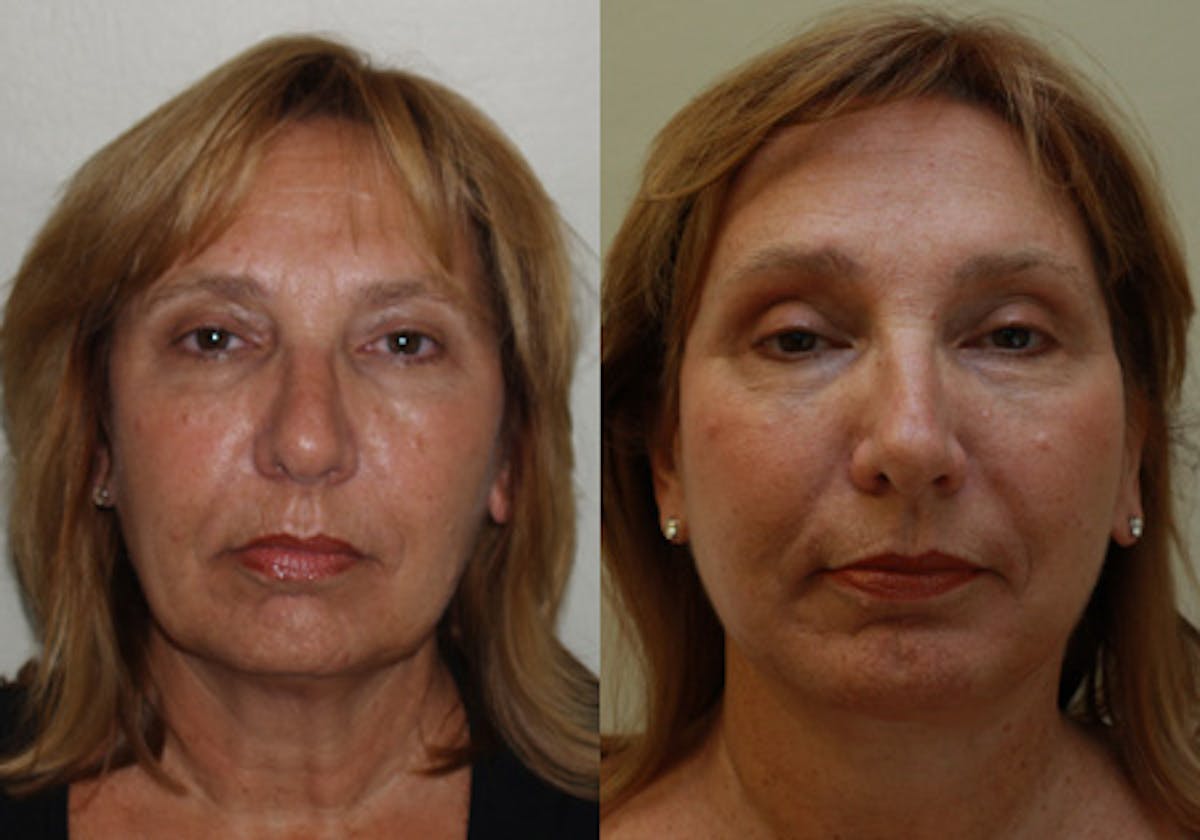 Face Before & After Gallery - Patient 288629 - Image 1