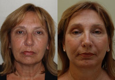 Face Before & After Gallery - Patient 288629 - Image 1