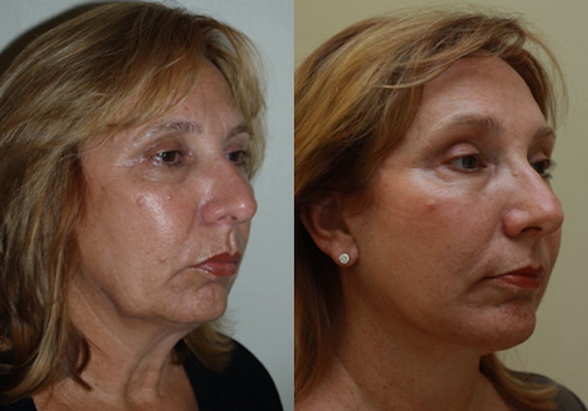 Face Before & After Gallery - Patient 288629 - Image 2
