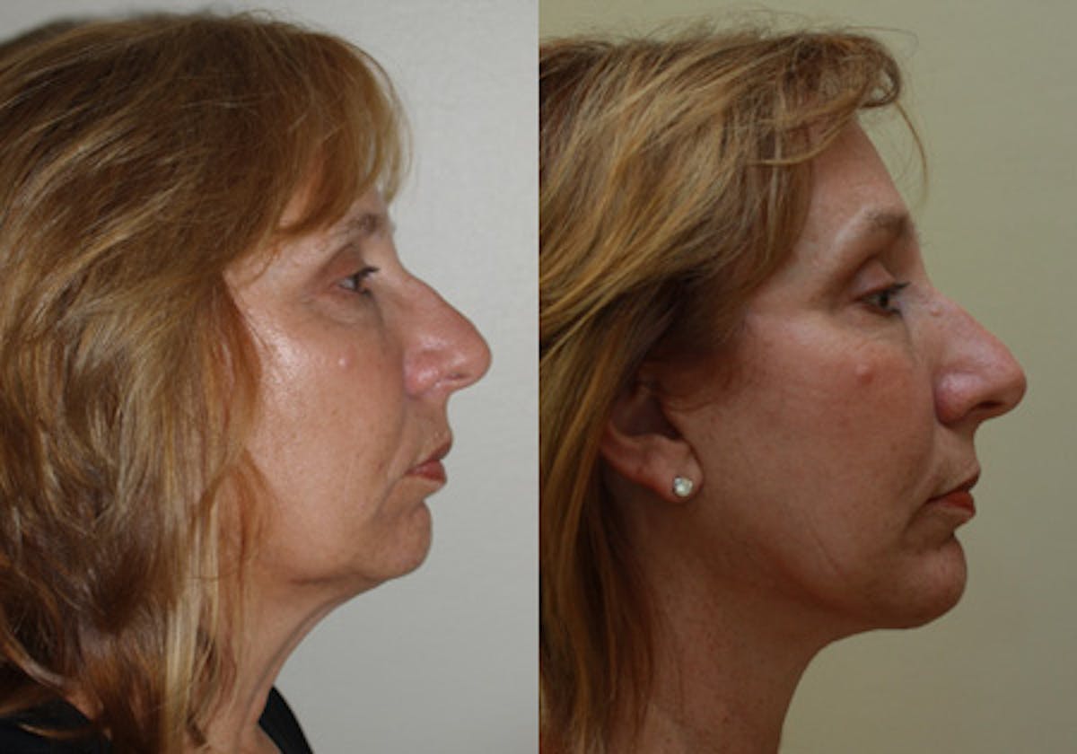 Face Before & After Gallery - Patient 288629 - Image 3