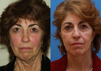 Face Before & After Gallery - Patient 172486 - Image 1