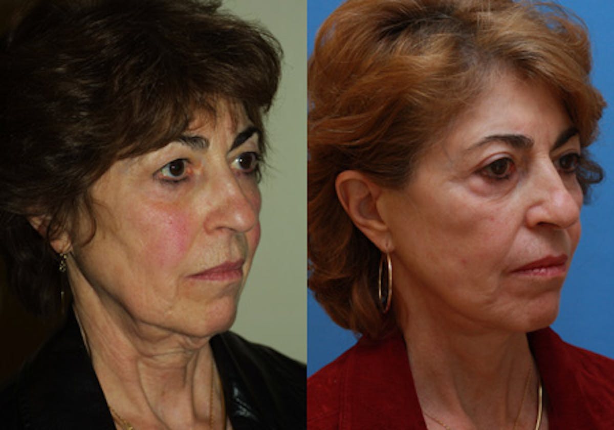 Face Before & After Gallery - Patient 172486 - Image 2