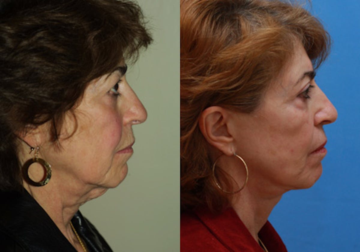 Face Before & After Gallery - Patient 172486 - Image 3