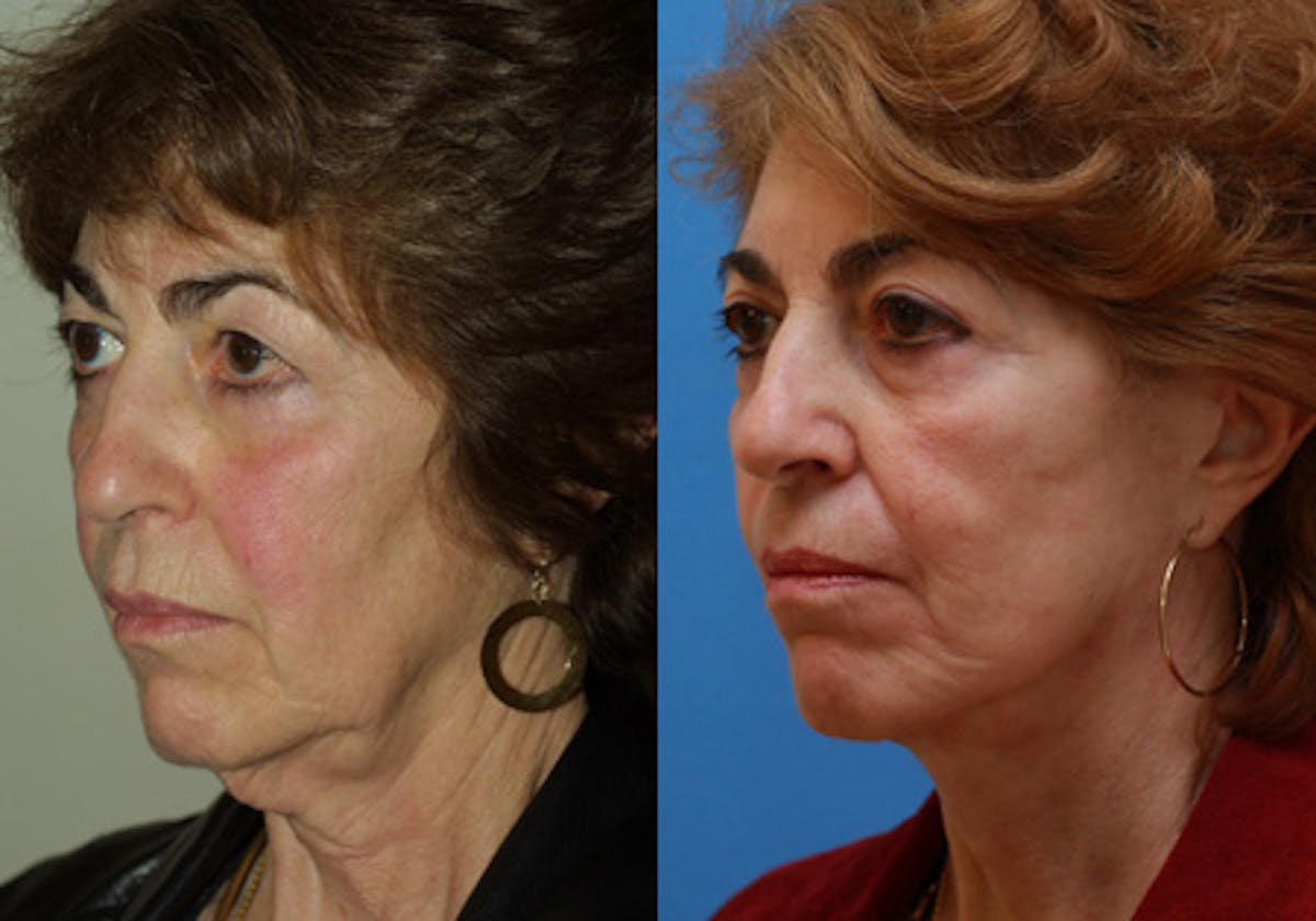 Face Before & After Gallery - Patient 172486 - Image 4