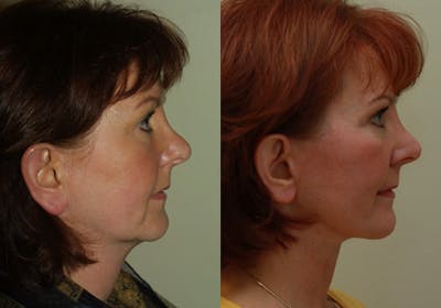Face Before & After Gallery - Patient 142572 - Image 1