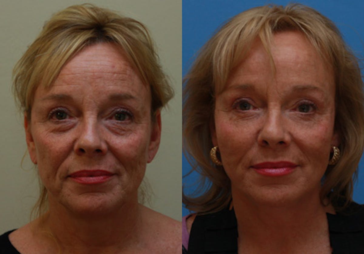 Face Before & After Gallery - Patient 771365 - Image 1