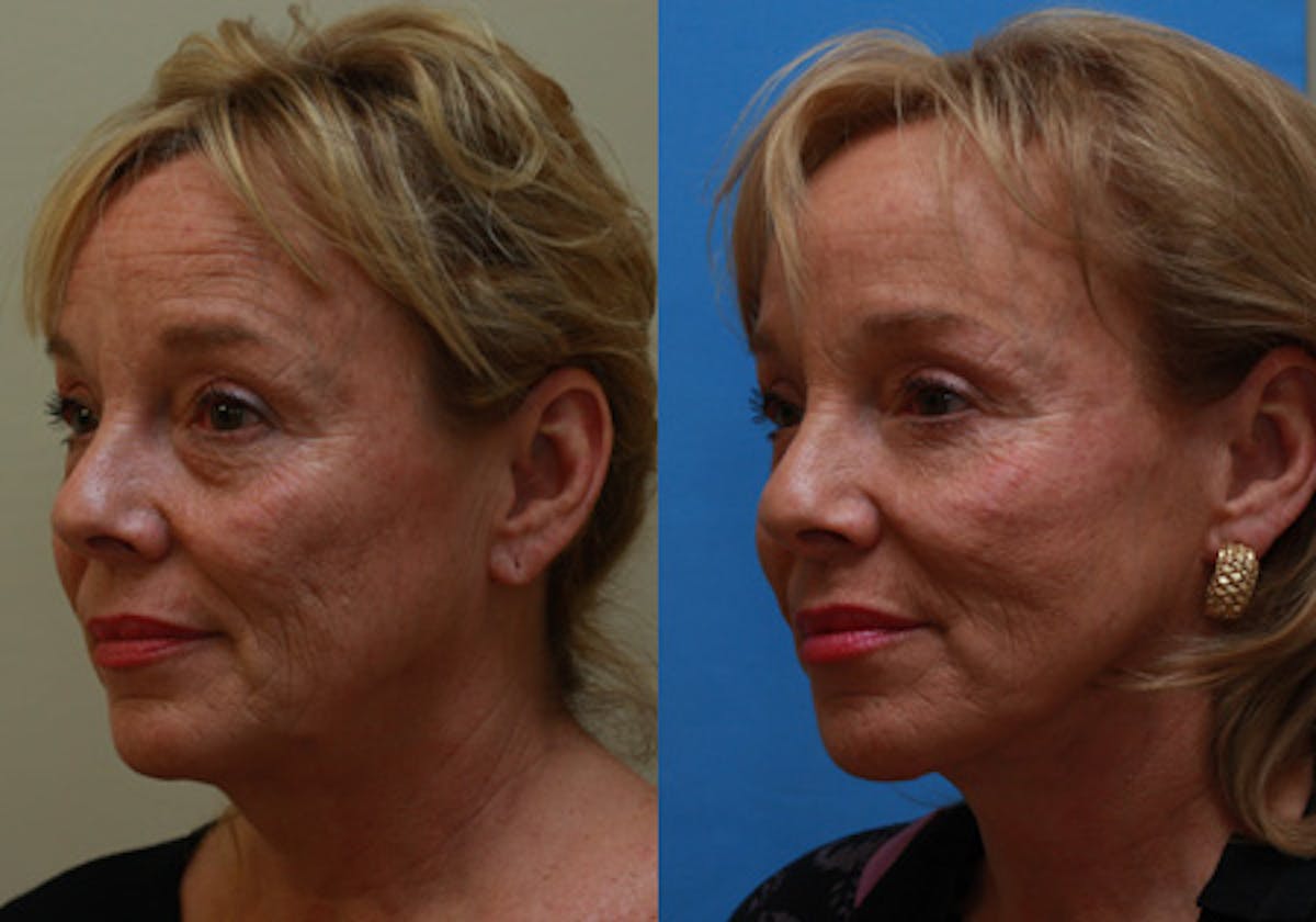 Face Before & After Gallery - Patient 771365 - Image 2