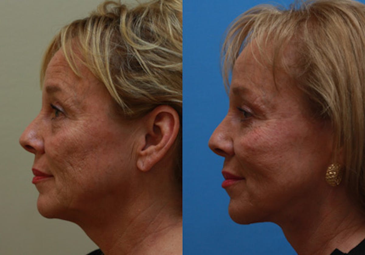 Face Before & After Gallery - Patient 771365 - Image 3