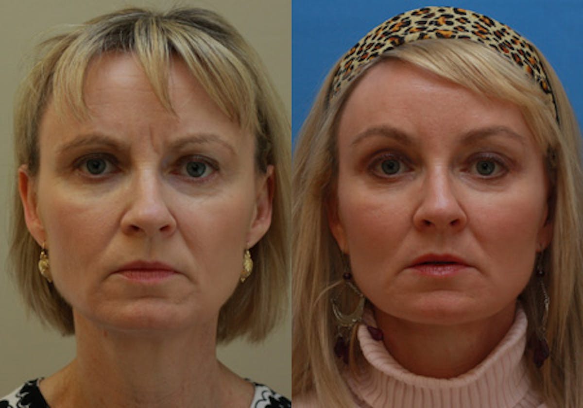 Face Before & After Gallery - Patient 296308 - Image 1