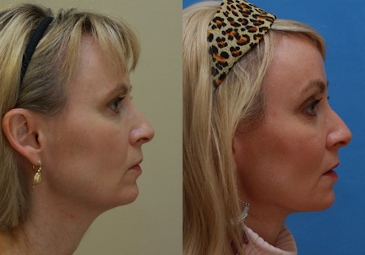 Face Before & After Gallery - Patient 296308 - Image 3