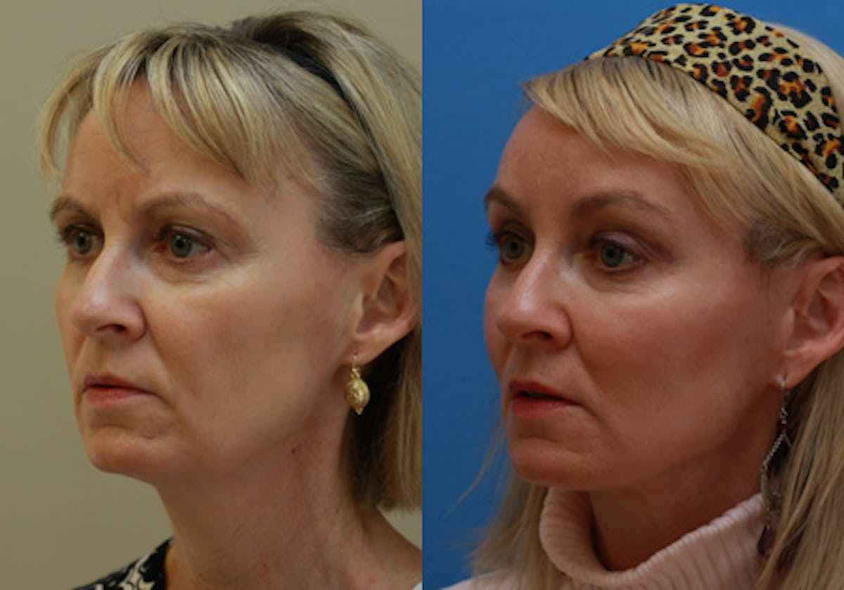 Face Before & After Gallery - Patient 296308 - Image 4