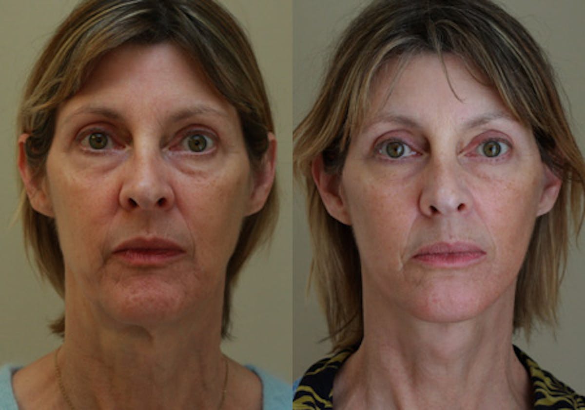Face Before & After Gallery - Patient 354455 - Image 1