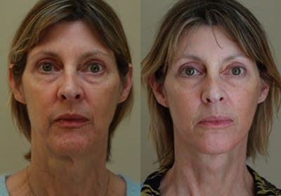 Face Before & After Gallery - Patient 354455 - Image 1