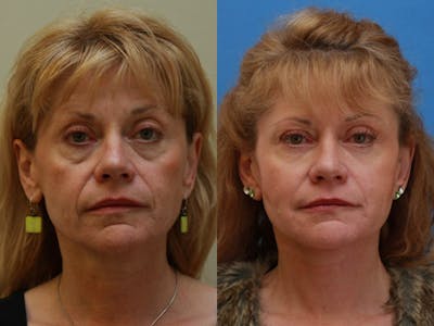 Face Before & After Gallery - Patient 305286 - Image 1