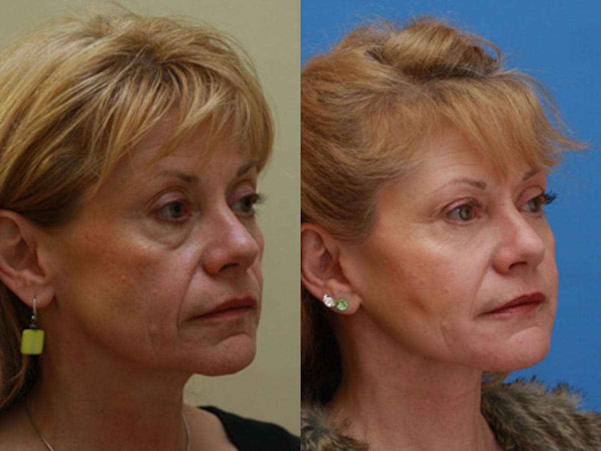 Face Before & After Gallery - Patient 305286 - Image 2