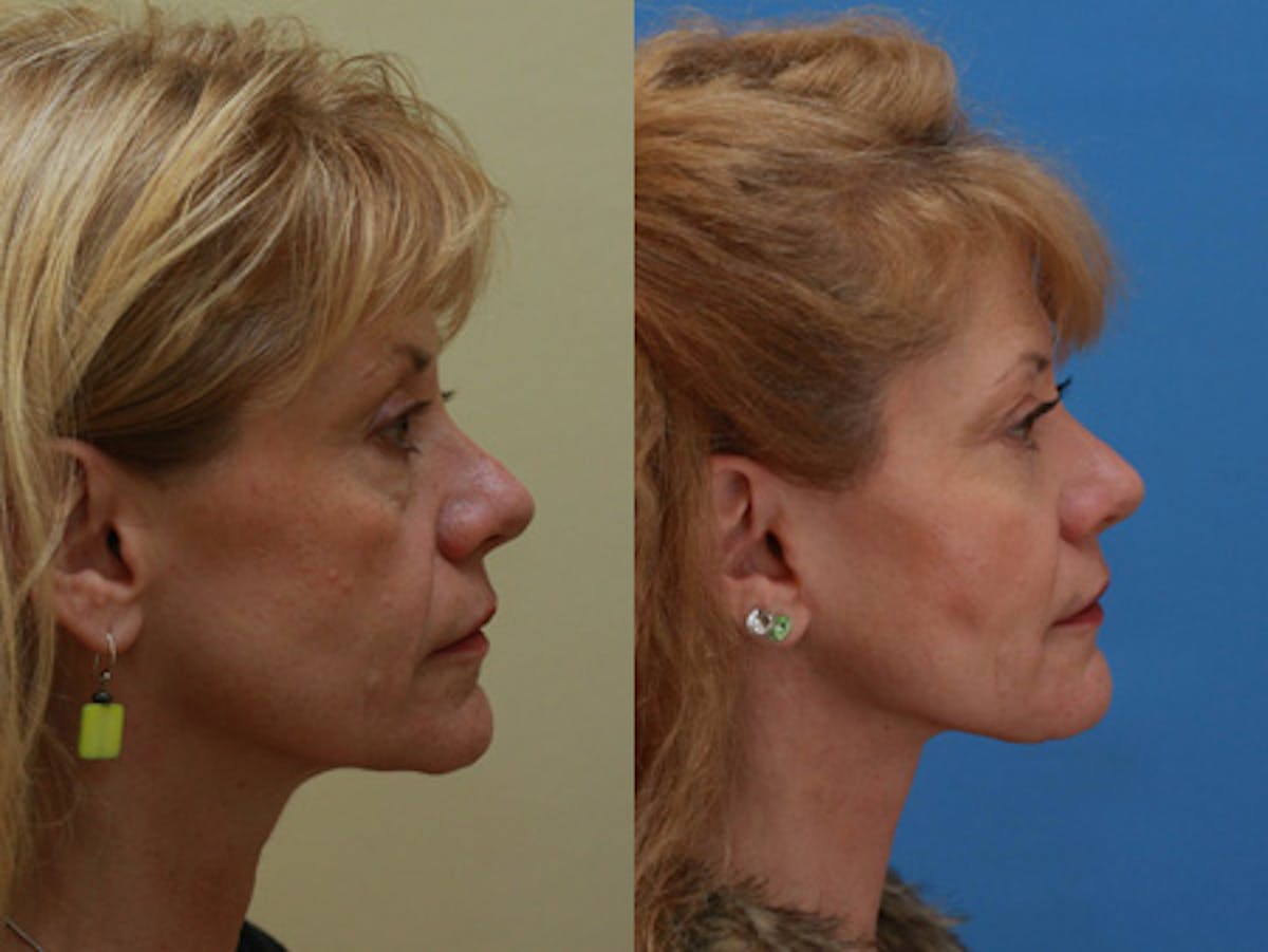 Face Before & After Gallery - Patient 305286 - Image 3