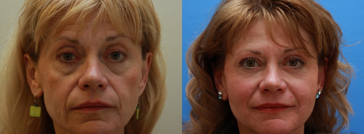 Face Before & After Gallery - Patient 305286 - Image 4