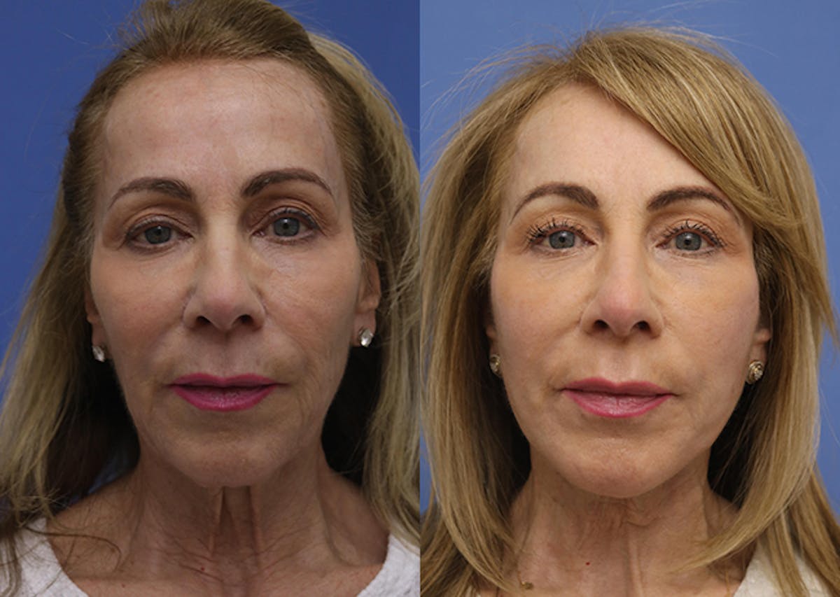 Neck Before & After Gallery - Patient 983095 - Image 1