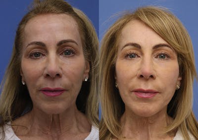 Neck Before & After Gallery - Patient 983095 - Image 1
