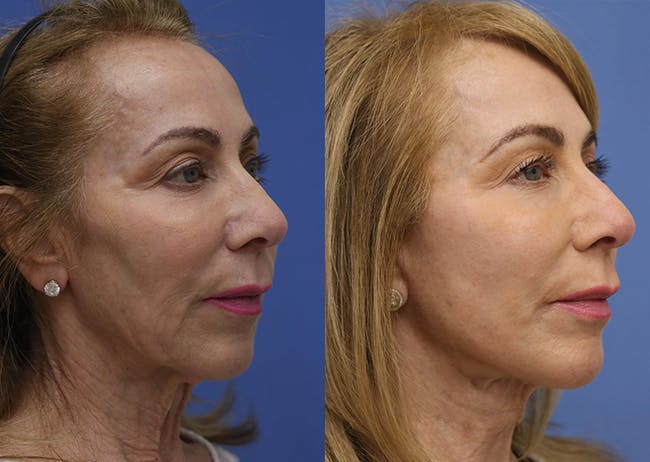 Face Before & After Gallery - Patient 262711 - Image 2