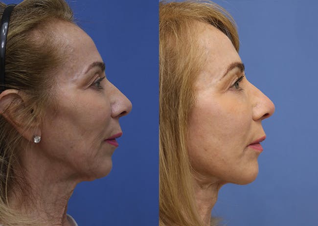 Face Before & After Gallery - Patient 262711 - Image 3