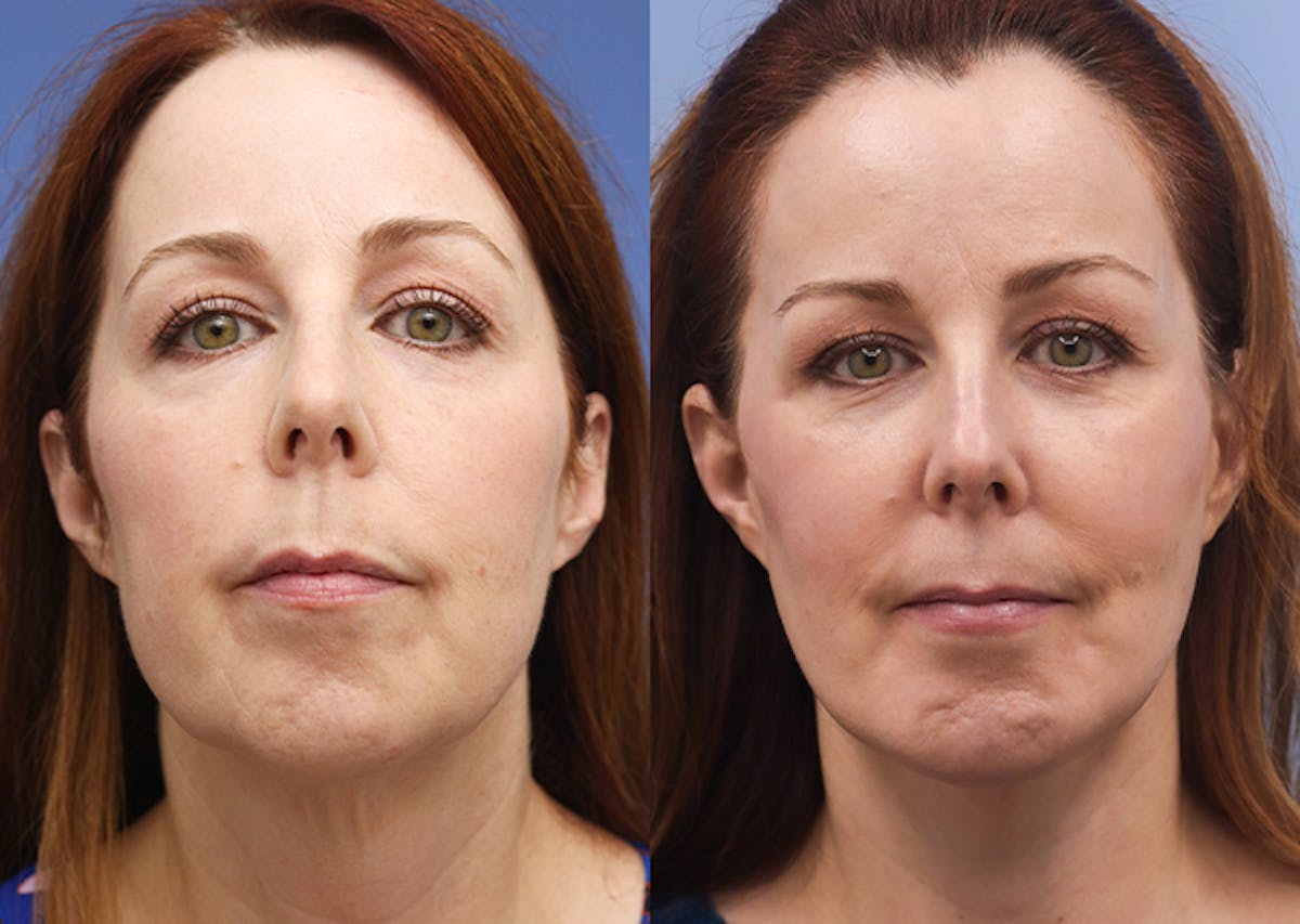 Face Before & After Gallery - Patient 618803 - Image 1
